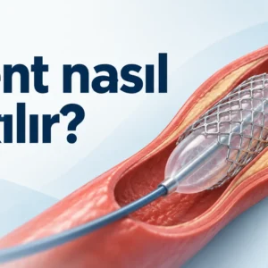 Stent nasıl takılır?